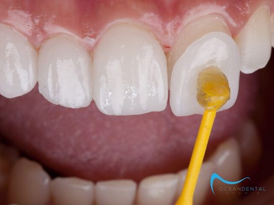 Featured image for “5 Things You Need To Know Before Getting Dental Veneers”