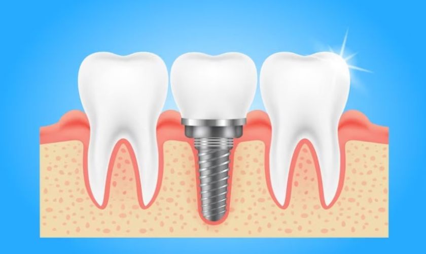 Featured image for “Why Dental Implants Are The Future of Tooth Replacement”