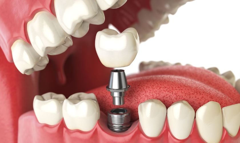 Featured image for “Restore Your Smile and Confidence with Dental Implants: Everything You Need to Know-”