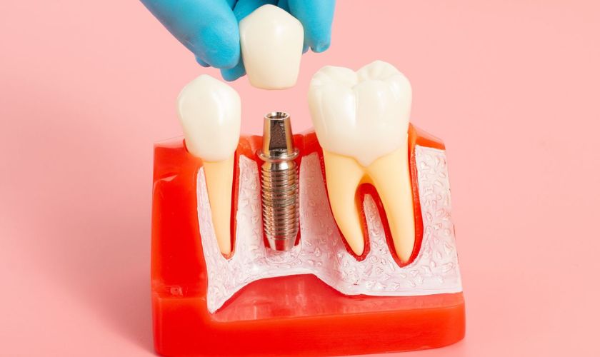 Featured image for “From Ancient Techniques to Modern Advancements In Dental Implants”