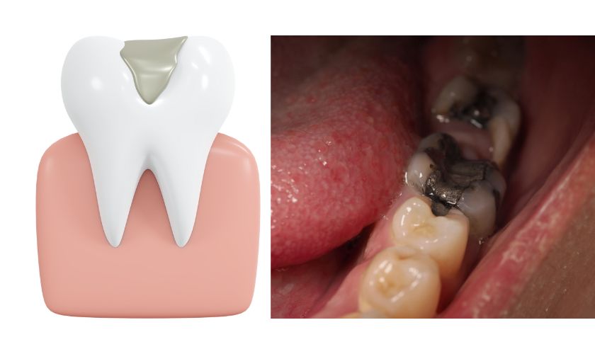 Featured image for “Silver or White: Choosing the Right Dental Filling Material for You”