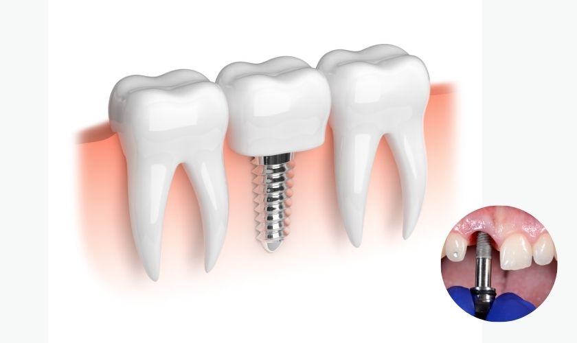 Featured image for “Dental Implants Surgery Aftercare Tips to Ensure Success”